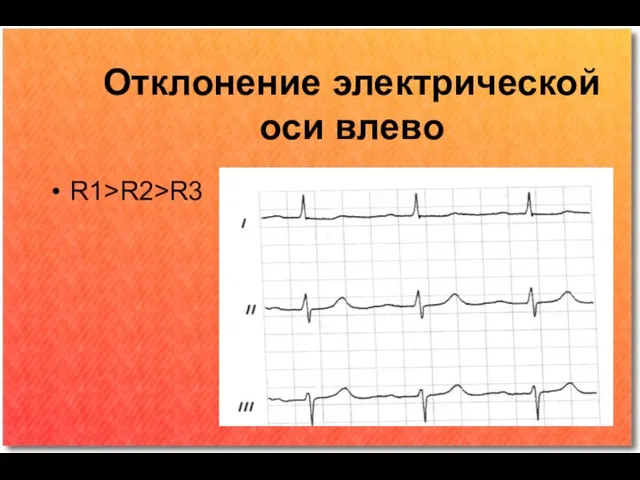 Отклонение электрической оси влево R1>R2>R3