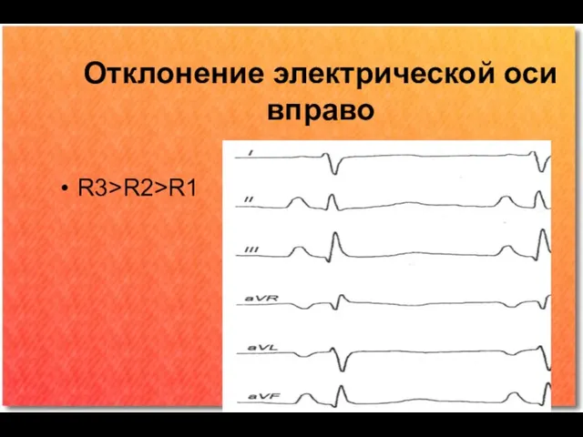 Отклонение электрической оси вправо R3>R2>R1