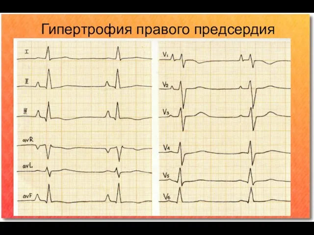 Гипертрофия правого предсердия