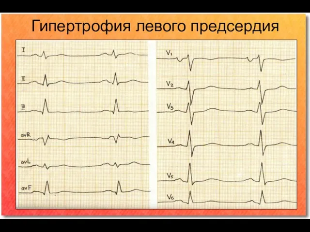 Гипертрофия левого предсердия