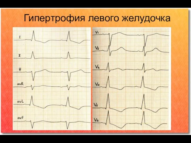 Гипертрофия левого желудочка