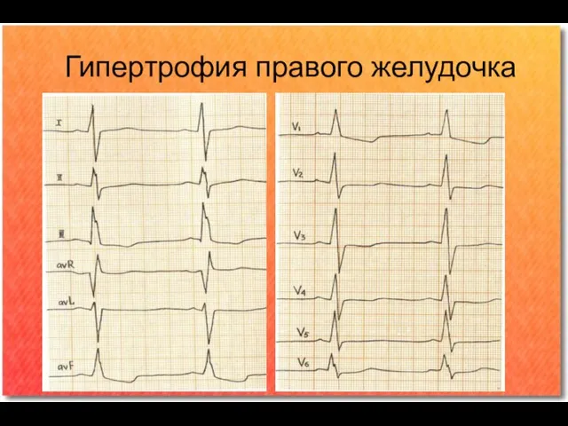 Гипертрофия правого желудочка