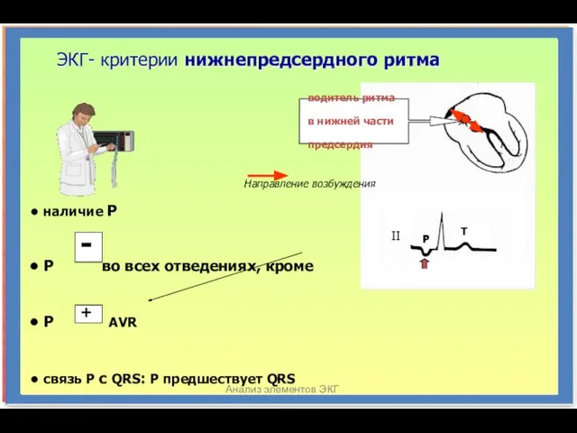 Анализ элементов ЭКГ ЭКГ- критерии нижнепредсердного ритма II P T водитель ритма