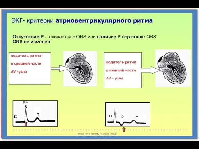 Анализ элементов ЭКГ ЭКГ- критерии атриовентрикулярного ритма Отсутствие Р - сливается с