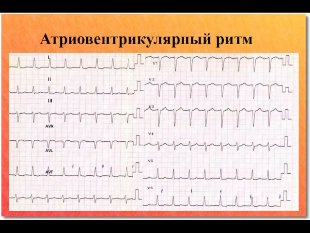 I II III AVR AVL AVF V1 Атриовентрикулярный ритм