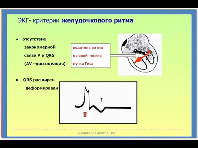 Анализ элементов ЭКГ ЭКГ- критерии желудочкового ритма водитель ритма в левой ножке