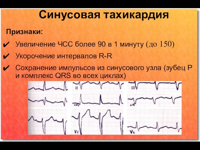 Синусовая тахикардия Признаки: Увеличение ЧСС более 90 в 1 минуту (до 150)