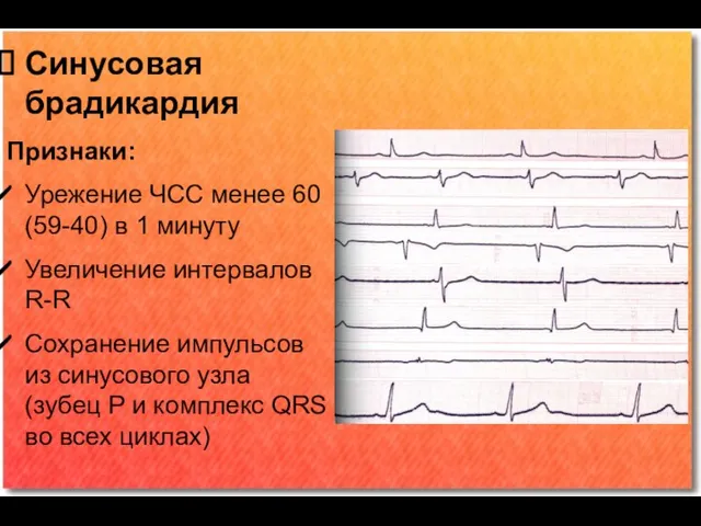 Синусовая брадикардия Признаки: Урежение ЧСС менее 60 (59-40) в 1 минуту Увеличение