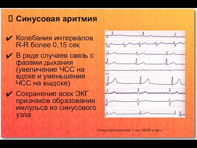 Синусовая аритмия Колебания интервалов R-R более 0,15 сек В ряде случаев связь