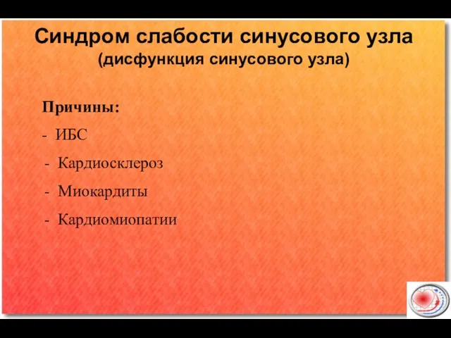 Синдром слабости синусового узла (дисфункция синусового узла) Причины: - ИБС Кардиосклероз Миокардиты Кардиомиопатии