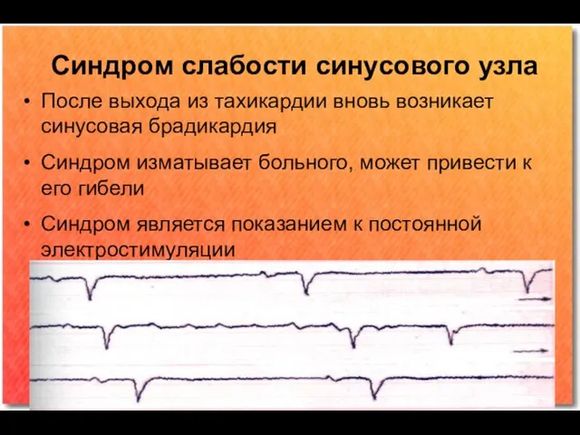 Синдром слабости синусового узла После выхода из тахикардии вновь возникает синусовая брадикардия