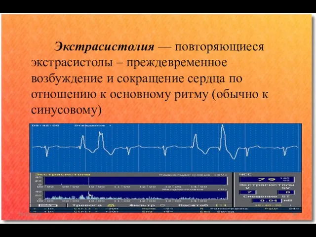 Экстрасистолия — повторяющиеся экстрасистолы – преждевременное возбуждение и сокращение сердца по отношению