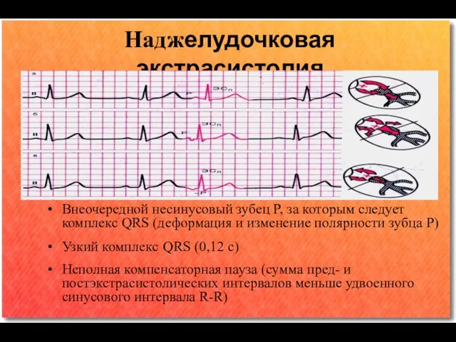 Наджелудочковая экстрасистолия Внеочередной несинусовый зубец P, за которым следует комплекс QRS (деформация