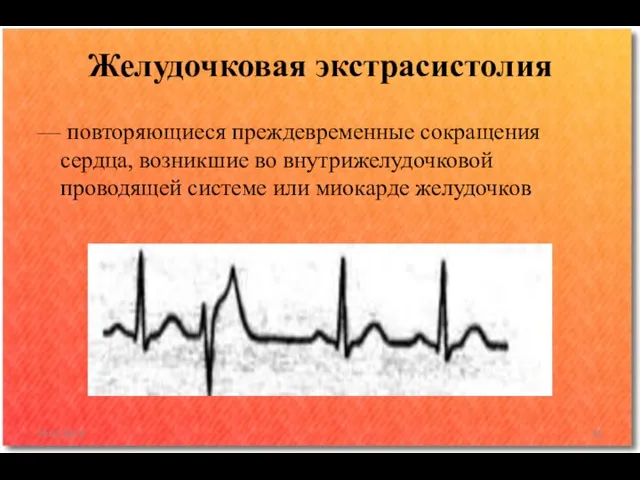 — повторяющиеся преждевременные сокращения сердца, возникшие во внутрижелудочковой проводящей системе или миокарде желудочков Желудочковая экстрасистолия 10.02.2016