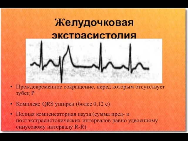 Желудочковая экстрасистолия Преждевременное сокращение, перед которым отсутствует зубец Р Комплекс QRS уширен