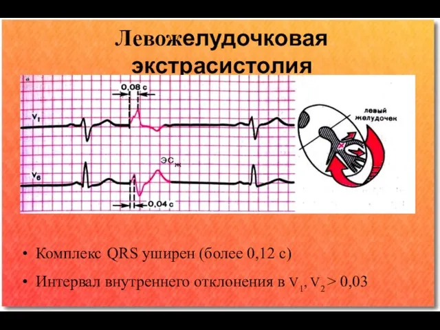 Левожелудочковая экстрасистолия Комплекс QRS уширен (более 0,12 с) Интервал внутреннего отклонения в V1, V2 ˃ 0,03