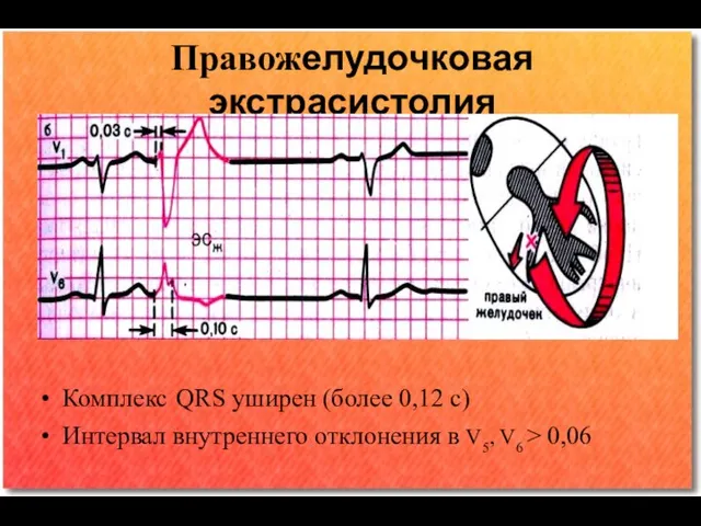 Правожелудочковая экстрасистолия Комплекс QRS уширен (более 0,12 с) Интервал внутреннего отклонения в V5, V6 ˃ 0,06