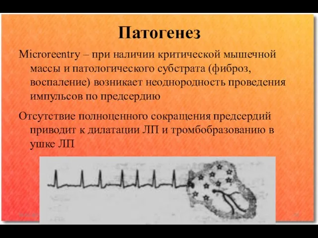 Microreentry – при наличии критической мышечной массы и патологического субстрата (фиброз, воспаление)