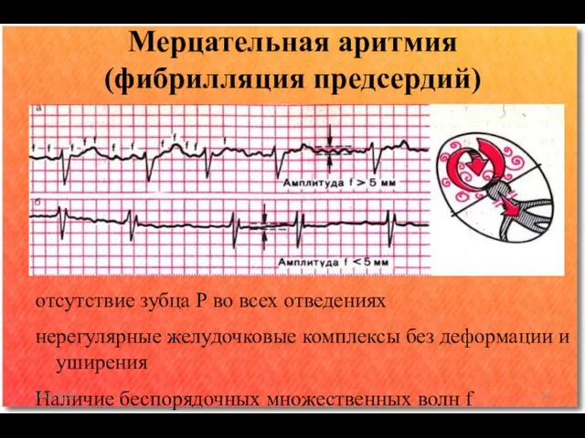 отсутствие зубца Р во всех отведениях нерегулярные желудочковые комплексы без деформации и