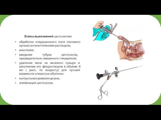 Этапы выполнения цистоскопии обработка операционного поля (полового органа) антисептическим раствором; анестезия; введение