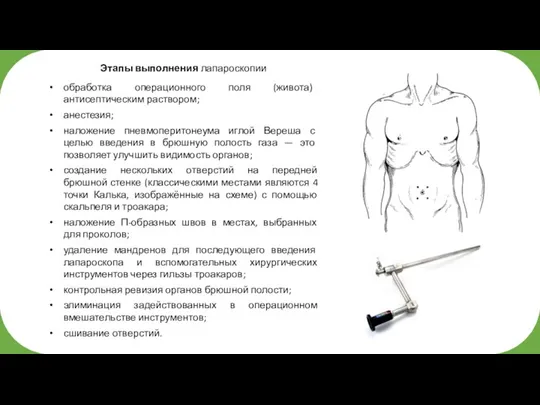 Этапы выполнения лапароскопии обработка операционного поля (живота) антисептическим раствором; анестезия; наложение пневмоперитонеума