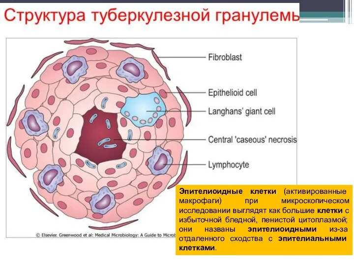 Эпителиоидные клетки (активированные макрофаги) при микроскопическом исследовании выглядят как большие клетки с