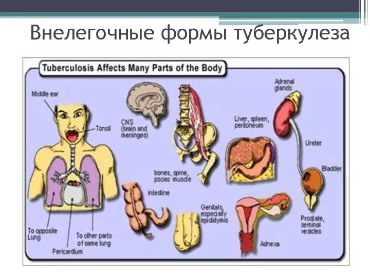 Внелегочные формы туберкулеза