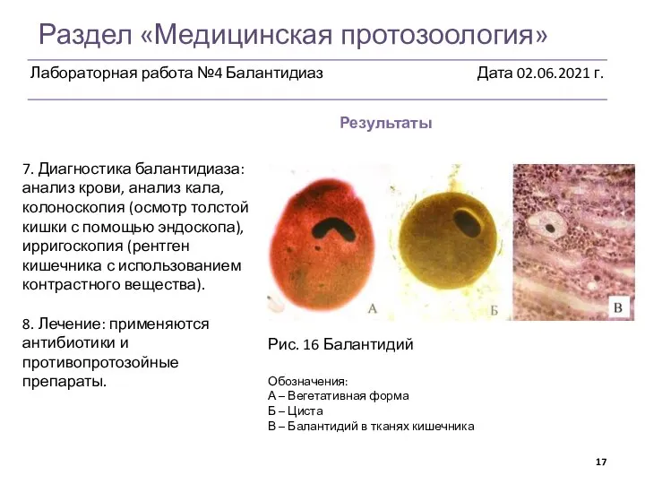 Раздел «Медицинская протозоология» Результаты Рис. 16 Балантидий Обозначения: А – Вегетативная форма