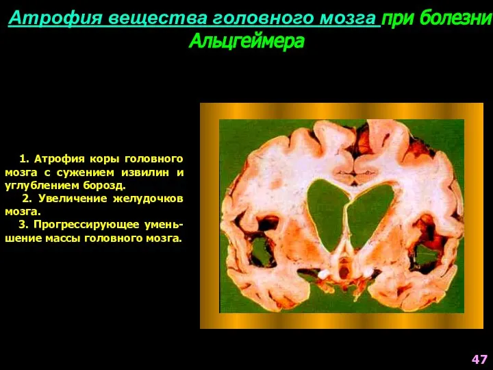 Атрофия вещества головного мозга при болезни Альцгеймера 1. Атрофия коры головного мозга