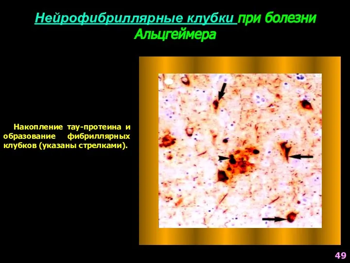 Нейрофибриллярные клубки при болезни Альцгеймера Накопление тау-протеина и образование фибриллярных клубков (указаны стрелками). 49