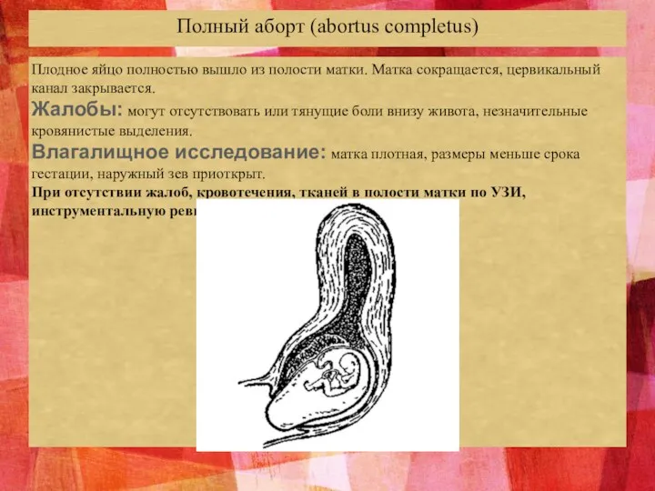 Полный аборт (abortus completus) Плодное яйцо полностью вышло из полости матки. Матка