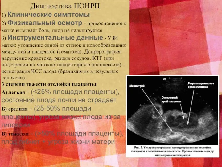 Диагностика ПОНРП 1) Клинические симптомы 2) Физикальный осмотр - прикосновение к матке