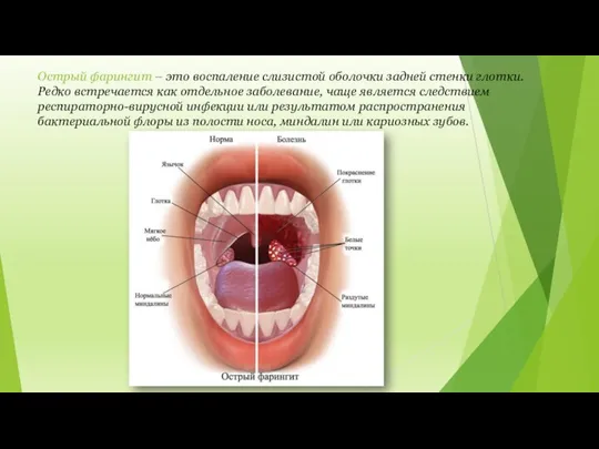 Острый фарингит – это воспаление слизистой оболочки задней стенки глотки. Редко встречается