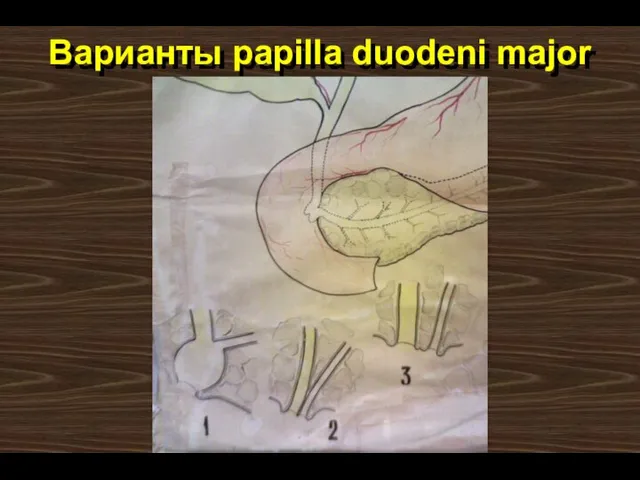 Варианты papilla duodeni major