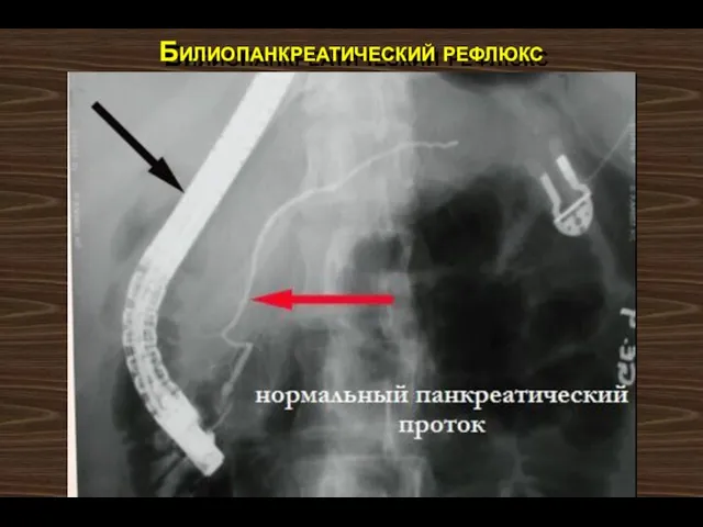 Билиопанкреатический рефлюкс