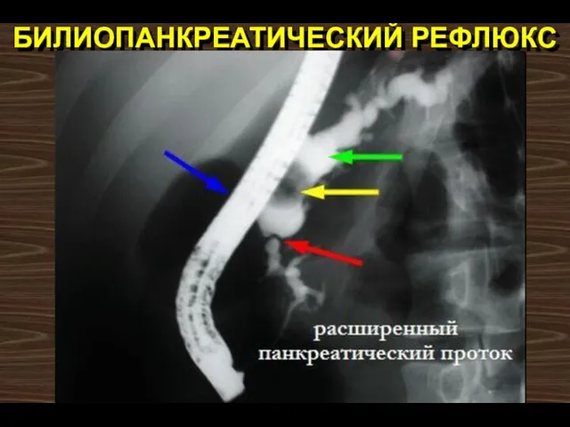 БИЛИОПАНКРЕАТИЧЕСКИЙ РЕФЛЮКС