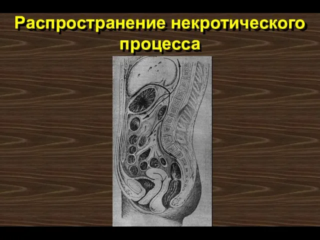 Распространение некротического процесса