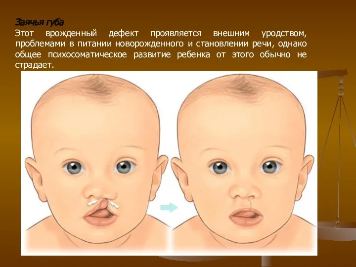 Заячья губа Этот врожденный дефект проявляется внешним уродством, проблемами в питании новорожденного
