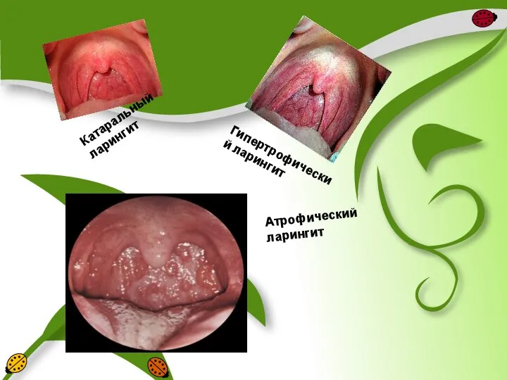 Катаральный ларингит Гипертрофический ларингит Атрофический ларингит