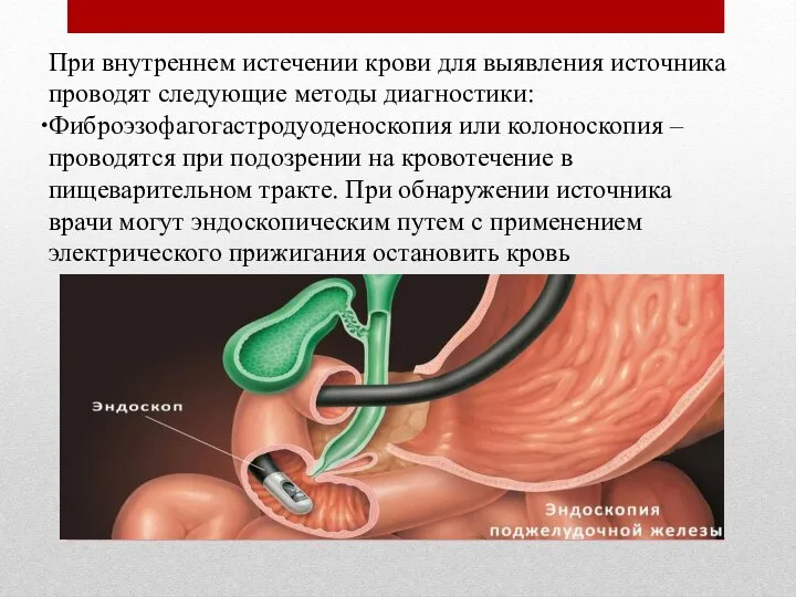 При внутреннем истечении крови для выявления источника проводят следующие методы диагностики: Фиброэзофагогастродуоденоскопия