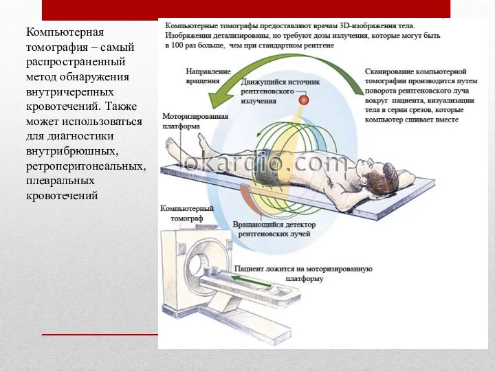 Компьютерная томография – самый распространенный метод обнаружения внутричерепных кровотечений. Также может использоваться