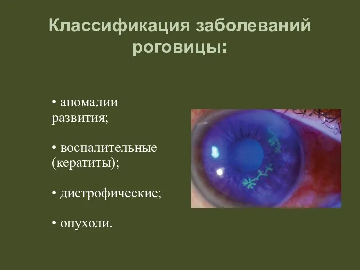 Классификация заболеваний роговицы: • аномалии развития; • воспалительные (кератиты); • дистрофические; • опухоли.