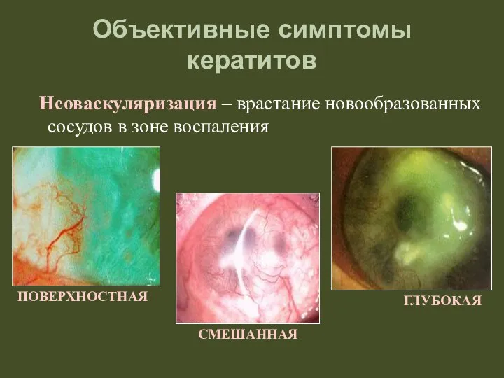 Объективные симптомы кератитов Неоваскуляризация – врастание новообразованных сосудов в зоне воспаления ГЛУБОКАЯ ПОВЕРХНОСТНАЯ СМЕШАННАЯ