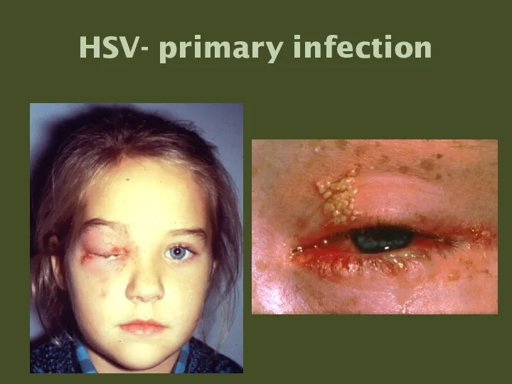 HSV- primary infection
