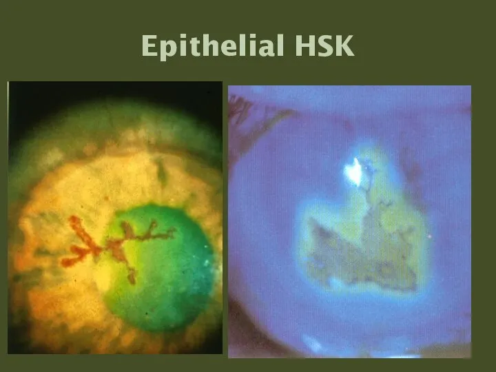 Epithelial HSK