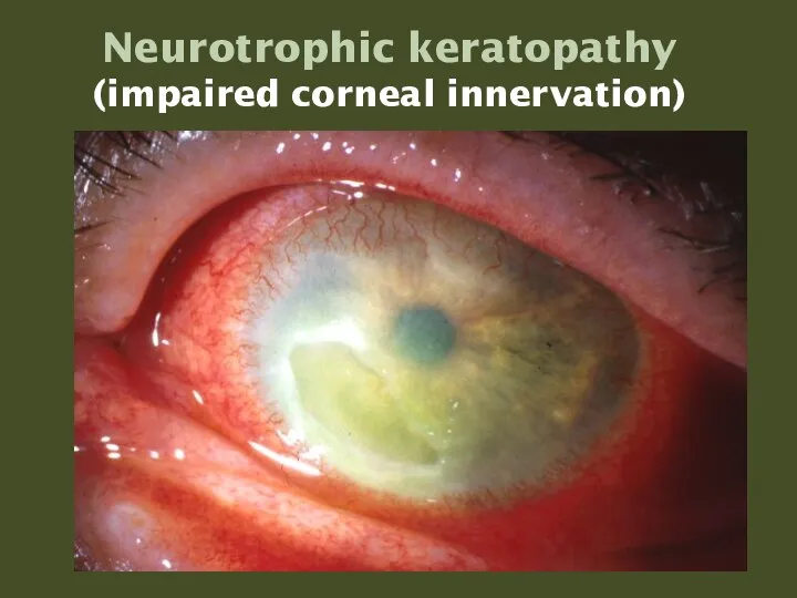 Neurotrophic keratopathy (impaired corneal innervation)