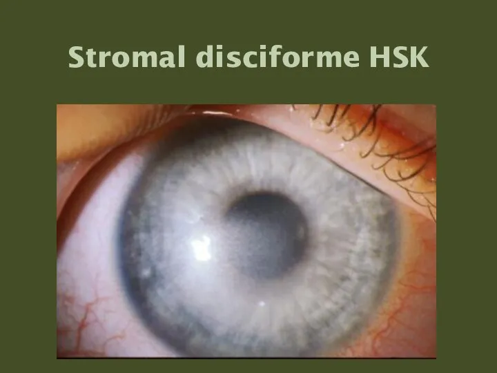 Stromal disciforme HSK