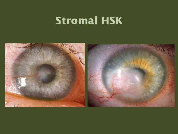 Stromal HSK