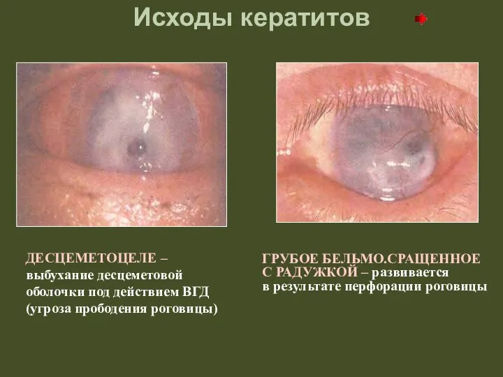 Исходы кератитов ДЕСЦЕМЕТОЦЕЛЕ – выбухание десцеметовой оболочки под действием ВГД (угроза прободения