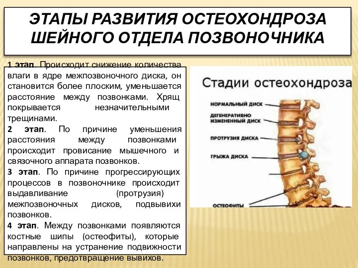 ЭТАПЫ РАЗВИТИЯ ОСТЕОХОНДРОЗА ШЕЙНОГО ОТДЕЛА ПОЗВОНОЧНИКА 1 этап. Происходит снижение количества влаги